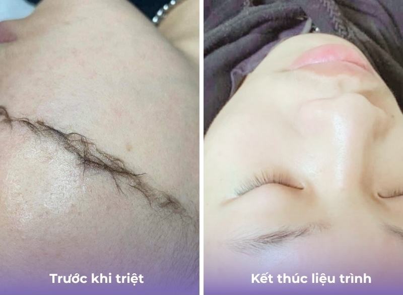 kết quả triệt lông mặt nữ 1