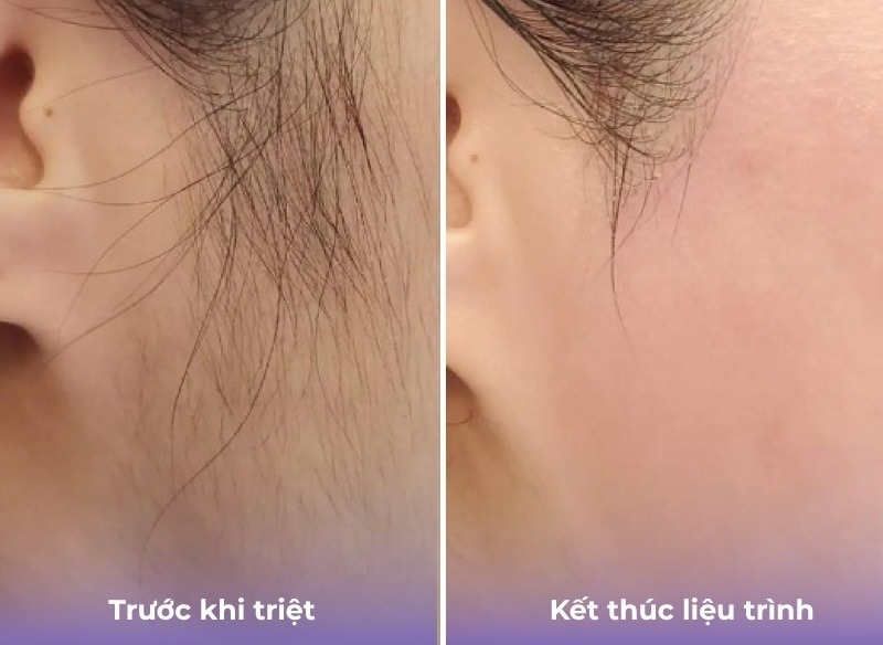 kết quả triệt lông mặt nữ 2