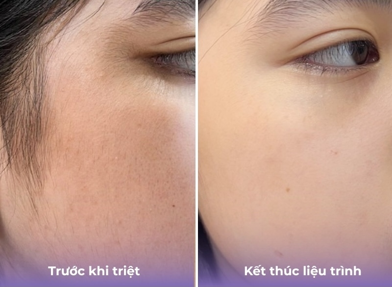 kết quả triệt lông mặt nữ 3