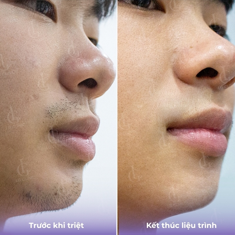 kết quả triệt lông mặt nam 1