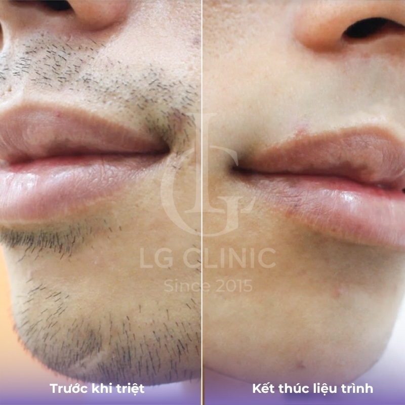 kết quả triệt lông mặt nam 2