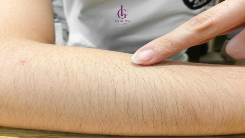 triệt lông cho người mắc hội chứng rậm lông