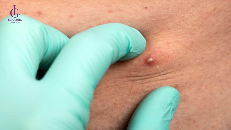 vùng kín bà bầu bị viêm nang lông nhẹ