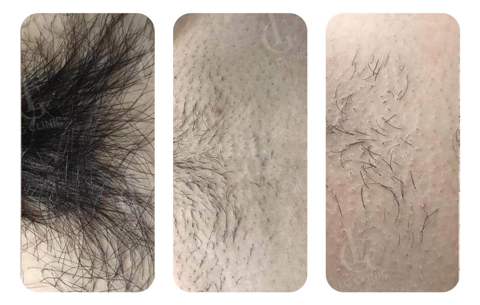 bộ 3 hình ảnh sau khi triệt lông vùng kín
