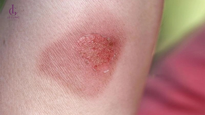 bỏng da do triệt lông