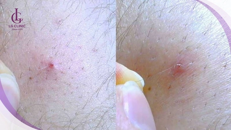 cách cạo lông nách không đúng gây lông mọc ngược