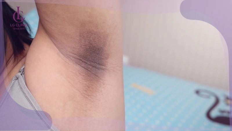 cách cạo lông nách không đúng gây thâm nách