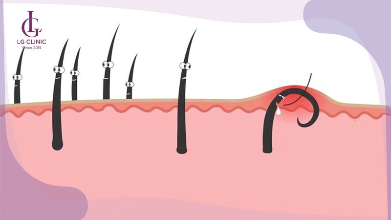 cách trị lông mọc ngược ở vùng kín