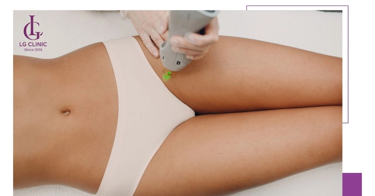 trị thâm bẹn háng bằng laser