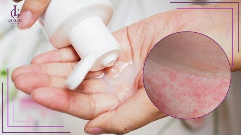 cạo lông vùng kín bị ngứa do dị ứng dung dịch vệ sinh