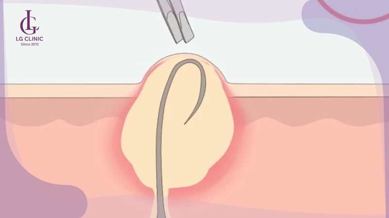 cạo lông vùng kín bị ngứa do lông mọc ngược