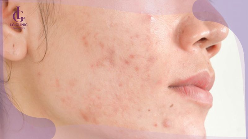 cạo lông vùng kín nữ bị kích ứng