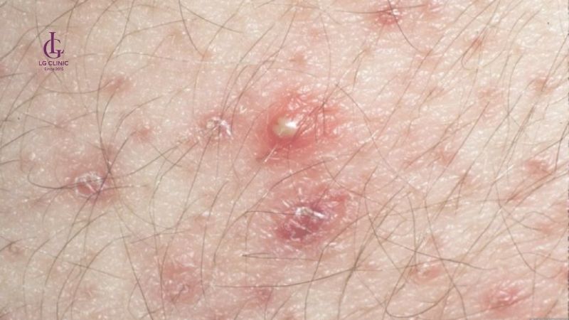 rủi ro bị ngứa khi sử dụng kem tẩy lông vùng kín