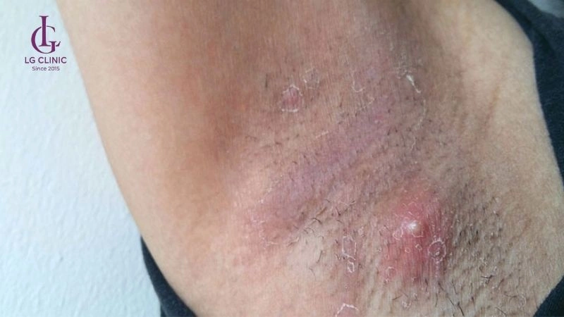 da nách sần sùi sau khi nhổ lông có sao không