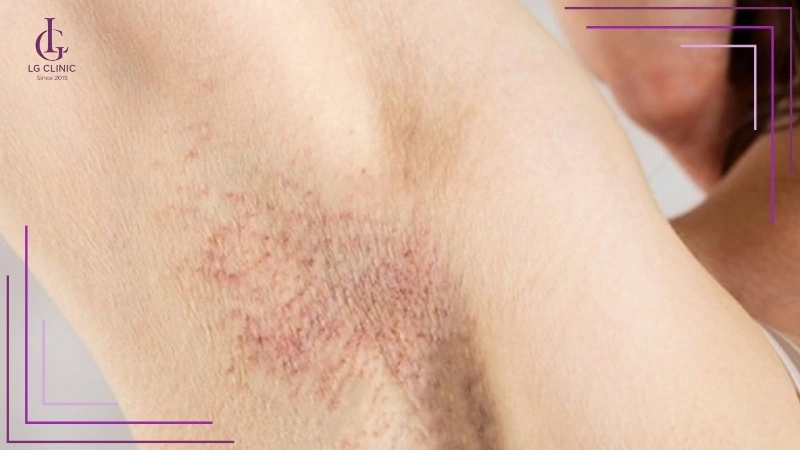dấu hiệu nhận biết viêm nang lông nách