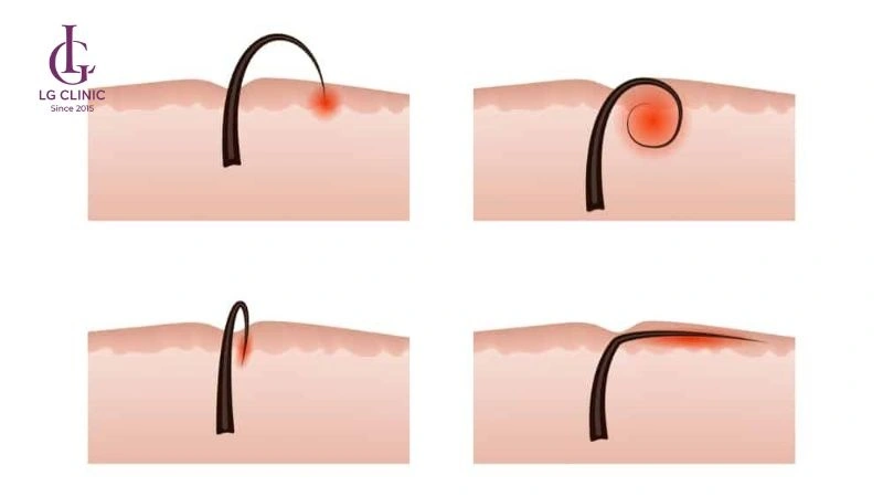 dễ bị lông mọc ngược