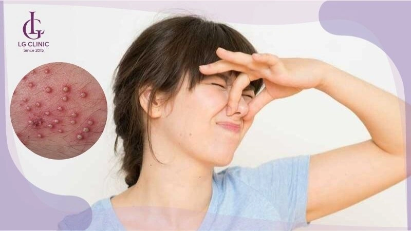 điều trị hôi nách do viêm nang lông