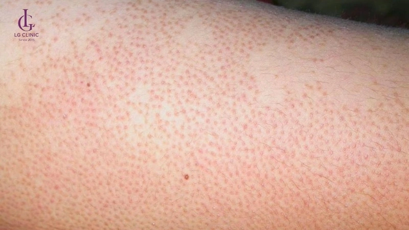 đỏ và kích ứng da do triệt lông