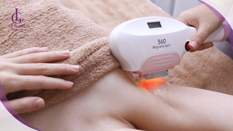 dùng laser giảm viêm nang lông nách