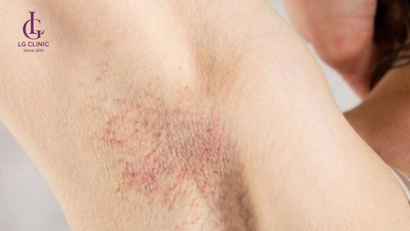 gây mụn, viêm lỗ chân lông