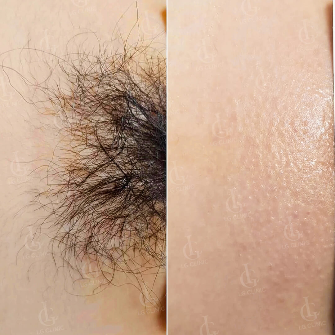 hình ảnh sau khi triệt lông vùng kín cho nữ