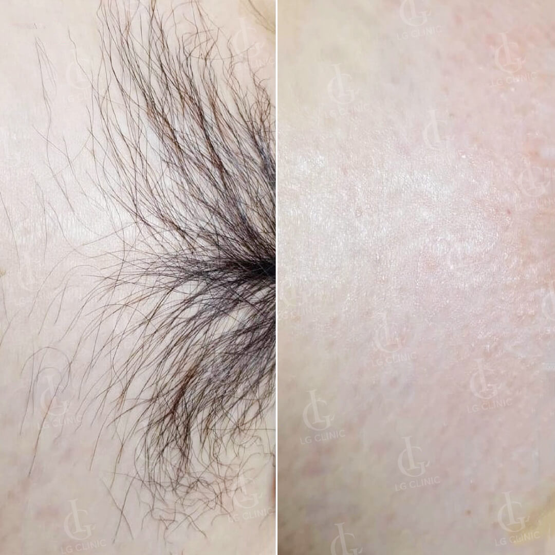 hình ảnh sau khi triệt lông vùng kín lông dài