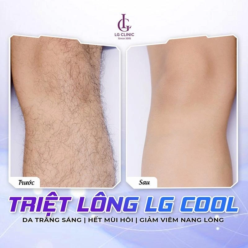 hình ảnh triệt lông của khách hàng nam tại lg clinic