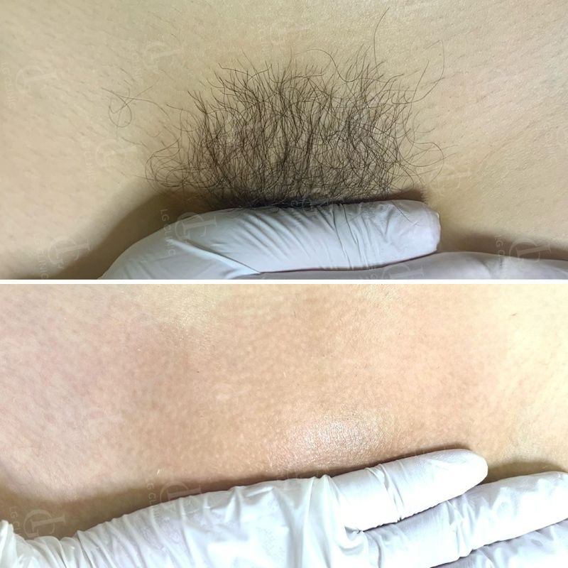 hình ảnh trước và sau khi triệt lông vùng kín