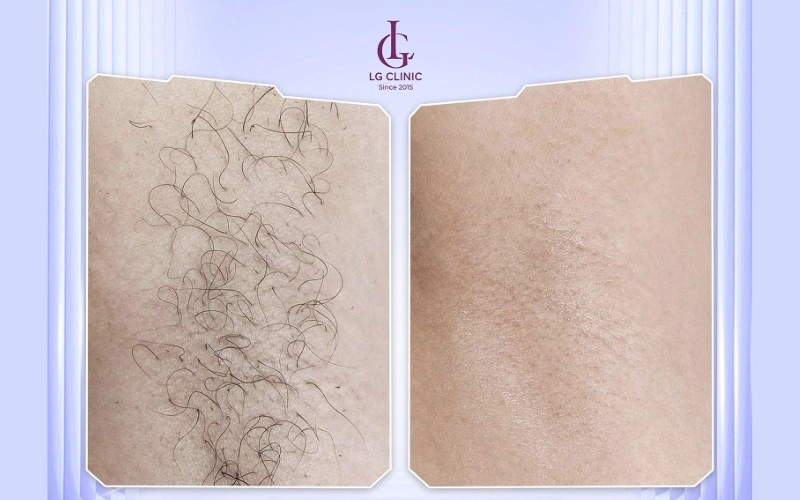 kết quả triệt lông nách