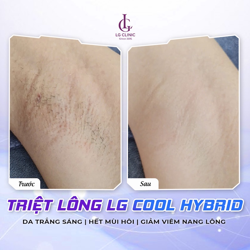 khác biệt sau khi triệt lông nách tại LG Clinic