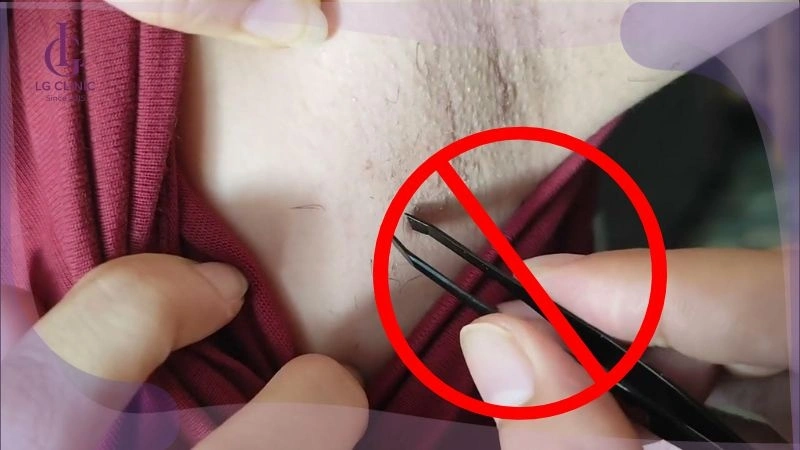 không nhổ lông nách sau khi triệt lông nách