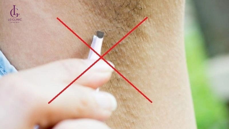 không nhổ lông trước khi triệt lông