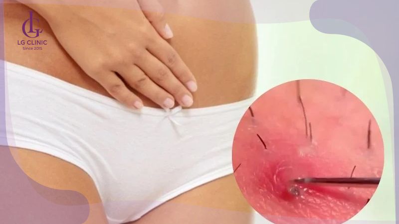 lông mọc ngược vùng kín do lỗ chân lông bị tắc nghẽn không tẩy tế bào chết