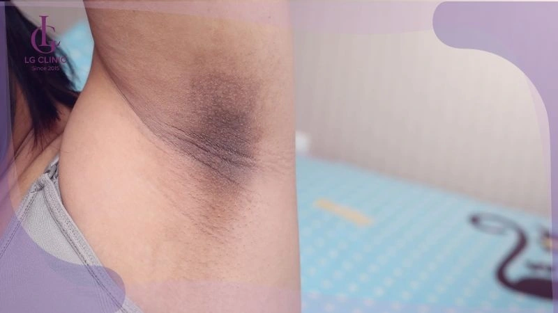nách bị thâm, sần sùi