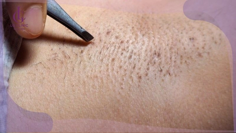 nên nhổ lông nách tuổi dậy thì không