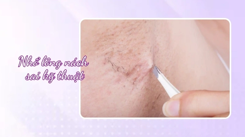 nhổ lông nách sai kĩ thuật