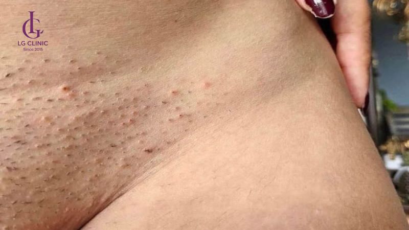 nhổ lông sai cách gây thâm vùng kín