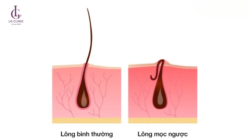 lông vùng kín mọc ngược khi nhổ lông