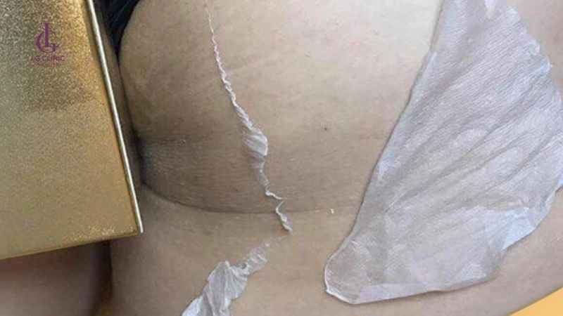 đúng quy trình peel trị thâm mông