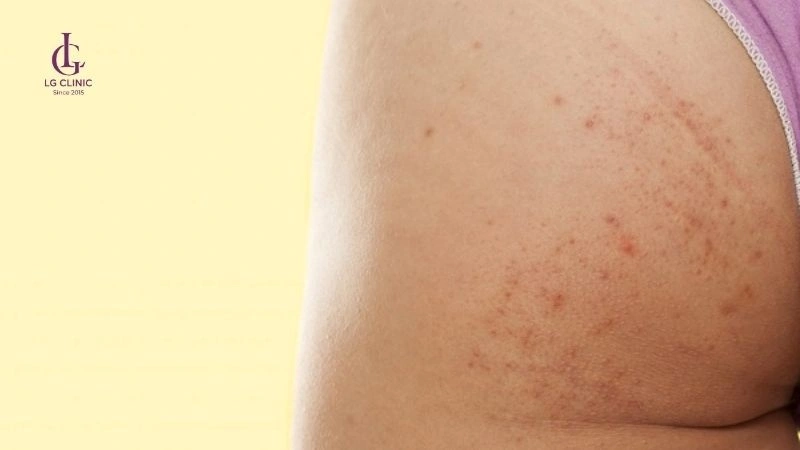 kích ứng khi peel da trị thâm vùng mông