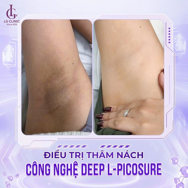 Deep L-Picosure