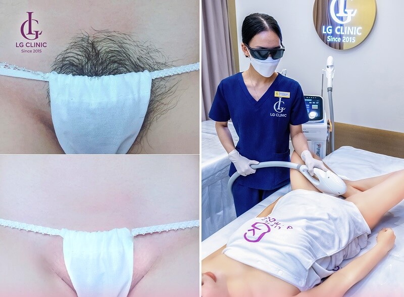 quy trình triệt lông vùng kín tại LG Clinic
