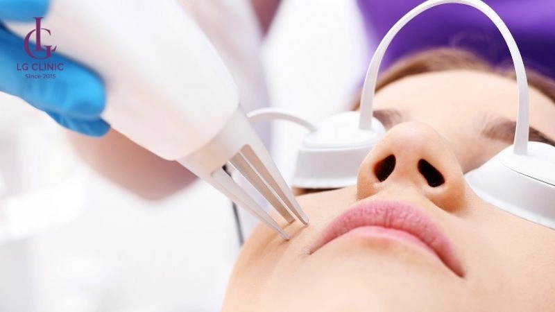 trị thâm bằng laser co2