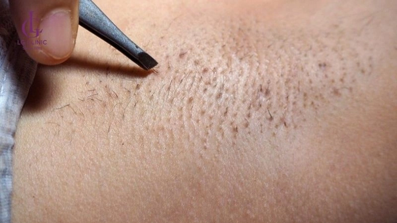 sau khi sinh bao lâu được nhổ lông nách