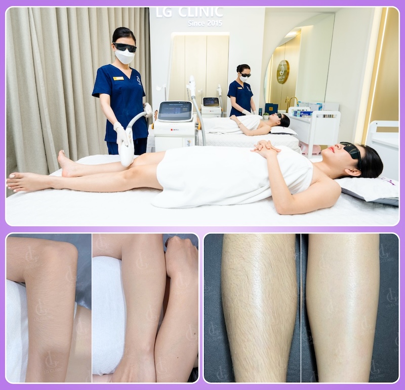 triệt lông tay chân