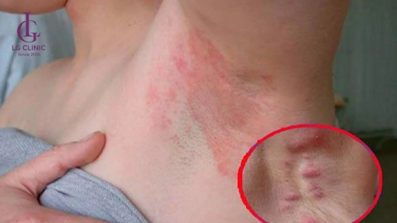 tẩy lông nách bị rát và nôi mẫn đỏ