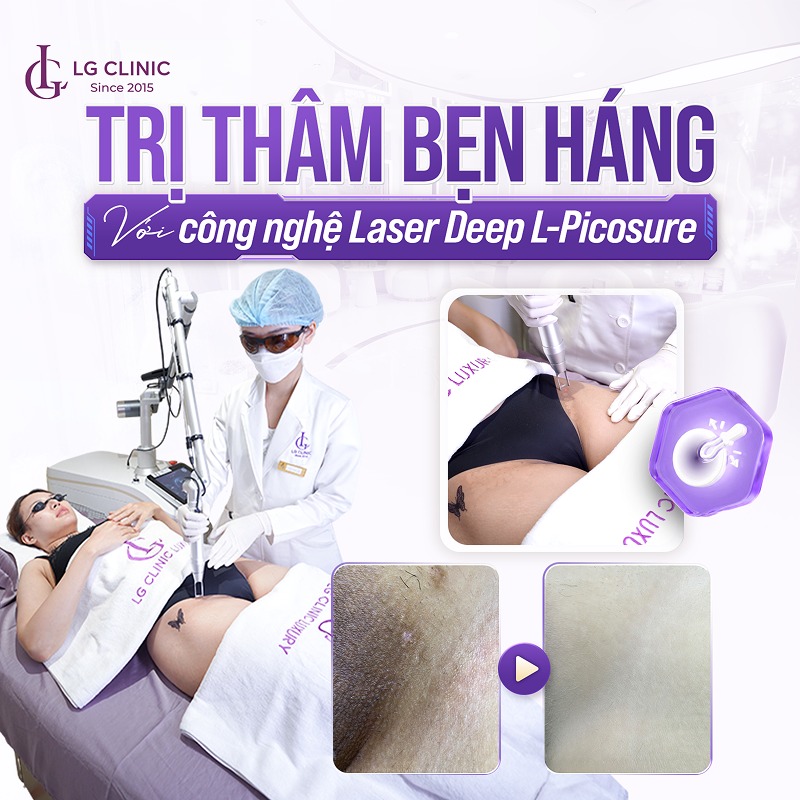 trị thâm bẹn