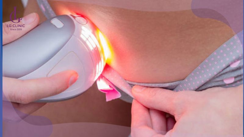 triệt lông vùng kín bằng công nghệ ánh sáng