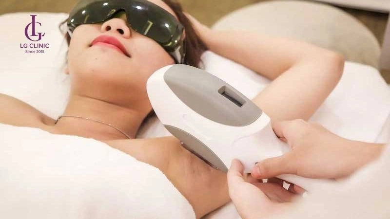 triệt lông nách bằng công nghệ hiện đại