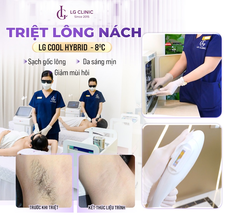 triệt lông vĩnh viễn không đau rát tại LG Clinic